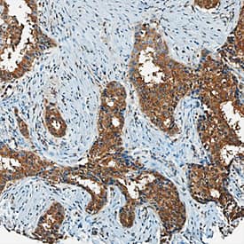CXCL5/ENA-78 antibody in Human Breast Cancer Tissue by Immunohistochemistry (IHC-P).