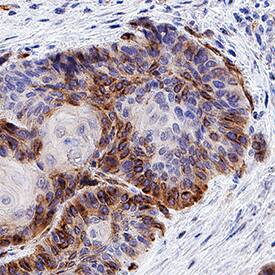 CXCR7/RDC-1 antibody in Human Squamous Cell Carcinoma by Immunohistochemistry (IHC-P).