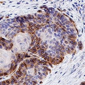 CXCR7/RDC-1 antibody in Human Squamous Cell Carcinoma by Immunohistochemistry (IHC-P).