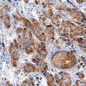 CXCR7/RDC-1 antibody in Human Breast Cancer Tissue by Immunohistochemistry (IHC-P).