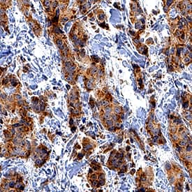 CXCR7/RDC-1 antibody in Human Breast Cancer Tissue by Immunohistochemistry (IHC-P).