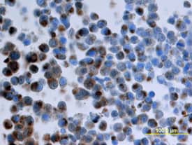 CXCR7/RDC-1 antibody in Human Breast Cancer Tissue by Immunohistochemistry (IHC-P).