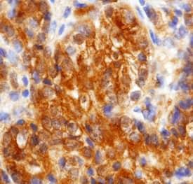 Cadherin-11 antibody in Human Prostate Cancer Tissue by Immunohistochemistry (IHC-P).