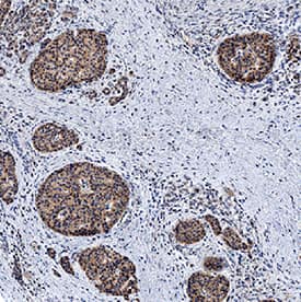 Calcitonin R antibody in Human Pancreatic Cancer Tissue by Immunohistochemistry (IHC-P).