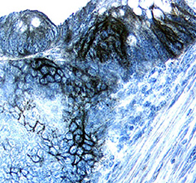 Carbonic Anhydrase IX/CA9 antibody in Human Colon Cancer Tissue by Immunohistochemistry (IHC-P).