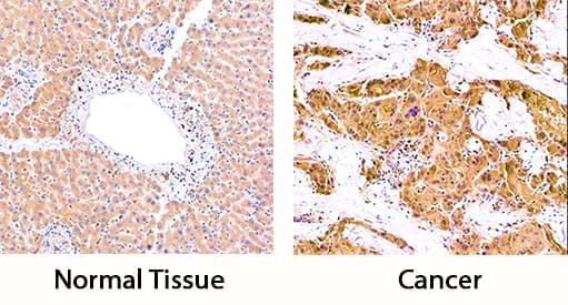 Carboxypeptidase B2/CPB2 antibody in Human Liver and Liver Cancer Tissue by Immunohistochemistry (IHC-P).