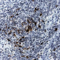 Caspase-3 antibody in Human Colon Cancer Tissue by Immunohistochemistry (IHC-P).