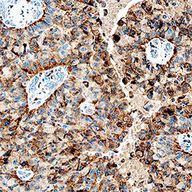 Cathepsin C/DPPI antibody in Human Lung Cancer Tissue by Immunohistochemistry (IHC-P).