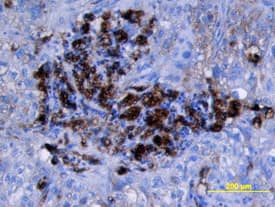 Cathepsin D antibody in Human Lung Cancer Tissue by Immunohistochemistry (IHC-P).