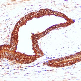 Cathepsin D antibody in Human Prostate Cancer Tissue by Immunohistochemistry (IHC-P).