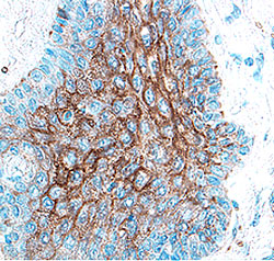 Cathepsin V antibody in Human Breast Cancer Tissue by Immunohistochemistry (IHC-P).