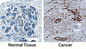 Cathepsin X/Z/P antibody in Human Breast and Breast Cancer Tissue by Immunohistochemistry (IHC-P).