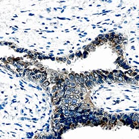 Chitinase 3-like 1 antibody in Human Ovarian Cancer by Immunohistochemistry (IHC-P).