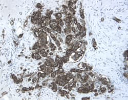 Chordin-like 2/CHRDL2 antibody in Human Breast Cancer Tissue by Immunohistochemistry (IHC-P).