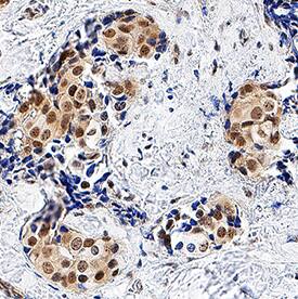Cited-2 antibody in Human Breast Cancer Tissue by Immunohistochemistry (IHC-P).