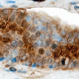 Claudin-19 antibody in Human Kidney Cancer Tissue by Immunohistochemistry (IHC-P).