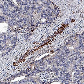 Clusterin antibody in Human Prostate Cancer Tissue by Immunohistochemistry (IHC-P).