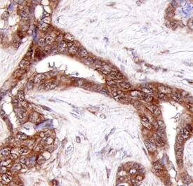 Collagen XXIII a1 antibody in Human Adenocarcinoma by Immunohistochemistry (IHC-P).