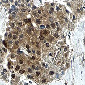 Cyclin D3 antibody in Human Breast Cancer Tissue by Immunohistochemistry (IHC-P).