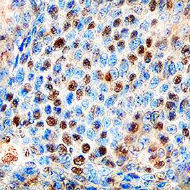 Cyclin E2 antibody in Human Cervical Cancer Tissue by Immunohistochemistry (IHC-P).