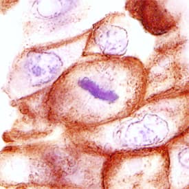Cytokeratin 18 antibody in Human Breast Cancer Tissue by Immunohistochemistry (IHC-P).