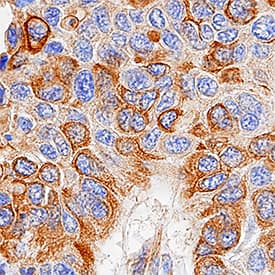 Cytokeratin 18 antibody in Human Squamous Cell Carcinoma by Immunohistochemistry (IHC-P).