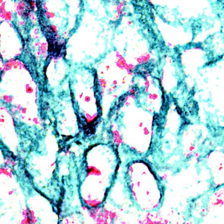 Cytokeratin 19 antibody in Human Breast Cancer Tissue Using Dual RNAscope®ISH and IHC.