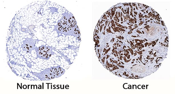 Cytokeratin 19 antibody in Human Breast Cancer Tissue by Immunohistochemistry (IHC-P).