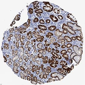 Cytokeratin 19 antibody in Human Gastric Cancer Tissue by Immunohistochemistry (IHC-P).