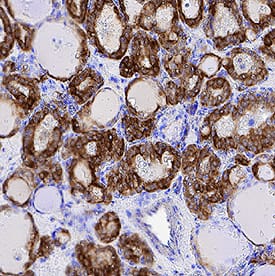 Cytokeratin 19 antibody in Human Papillary Thyroid Cancer Tissue by Immunohistochemistry (IHC-P).
