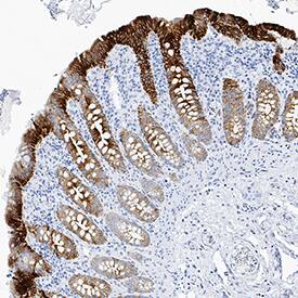 Cytokeratin 19 antibody in Human Lymphoma Tissue by Immunohistochemistry (IHC-P).