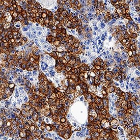 Cytokeratin 8 antibody in Human Colon Cancer Tissue by Immunohistochemistry (IHC-P).