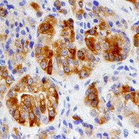 Cytosolic Sulfotransferase 2B1/SULT2B1 antibody in Human Prostate Cancer Tissue by Immunohistochemistry (IHC-P).