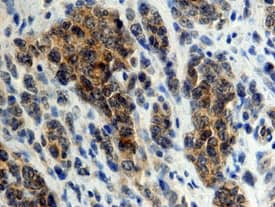 DC-SIGN+DC-SIGNR antibody in Human Lymphoma by Immunohistochemistry (IHC-P).