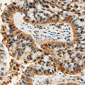 DDR2 antibody in Human Lung Cancer Tissue by Immunohistochemistry (IHC-P).