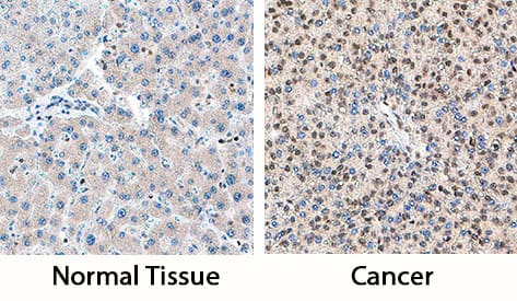 DDX17 antibody in Human Liver Cancer Tissue by Immunohistochemistry (IHC-P).