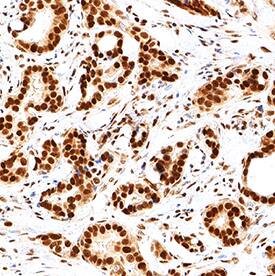 DDX1 antibody in Human Breast Cancer Tissue by Immunohistochemistry (IHC-P).