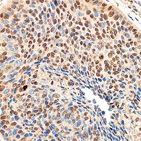 DEK antibody in Human Cervical Cancer Tissue by Immunohistochemistry (IHC-P).