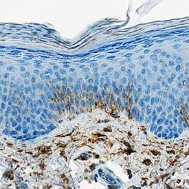 DPPIV/CD26 antibody in Human Psoriatic Skin by Immunohistochemistry (IHC-P).