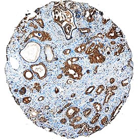 Digoxigenin-Conjugated Antibody antibody in Human Prostate Cancer Tissue by Immunohistochemistry (IHC-P).