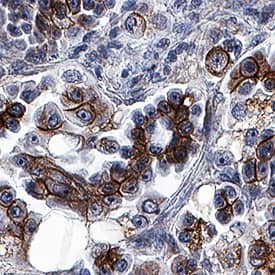 Cadherin antibody in Human Cystadenocarcinoma by Immunohistochemistry (IHC-P).