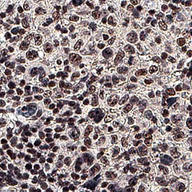 EGR1 antibody in Human Hodgkin's Lymphoma by Immunohistochemistry (IHC-P).