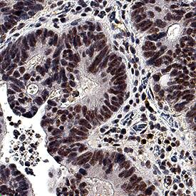 EGR1 antibody in Human Adenocarcinoma Tissue by Immunohistochemistry (IHC-P).