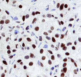 EGR1 antibody in Human Prostate Cancer Tissue by Immunohistochemistry (IHC-P).