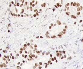EGR1 antibody in Human Prostate Cancer Tissue by Immunohistochemistry (IHC-P).
