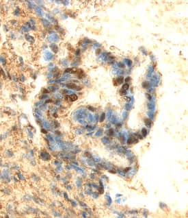 ERK3 antibody in Human Breast Cancer Tissue by Immunohistochemistry (IHC-P).