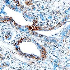 Endophilin B1/Bif-1 antibody in Human Pancreatic Cancer Tissue by Immunohistochemistry (IHC-P).