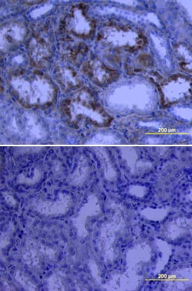 Endostatin antibody in Human Kidney Cancer Tissue by Immunohistochemistry (IHC-P).