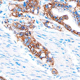 EpCAM/TROP-1 antibody in Human Adenocarcinoma by Immunohistochemistry (IHC-P).