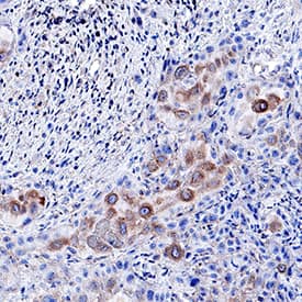 EphB2 antibody in Human Esophageal Squamous Cell Carcinoma by Immunohistochemistry (IHC-P).